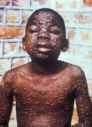 病毒感染发烧一般几天_病毒的症状_病毒性发烧有什么症状