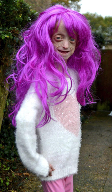 英国<em>11岁</em>早衰女童外貌惨不忍睹 皮肤褶皱松弛