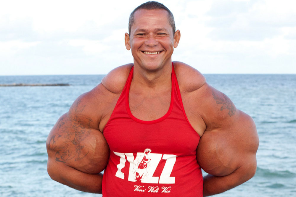 男子注射脂肪、精油、酒精混合物成现实版绿巨