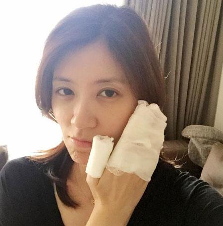 贾静雯被烫伤 天热真要记住烧烫伤宝典!