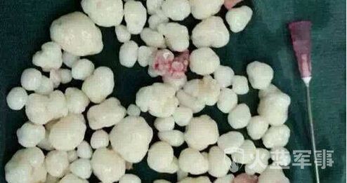 生理盐水一冲,上百颗肿瘤涌了出来