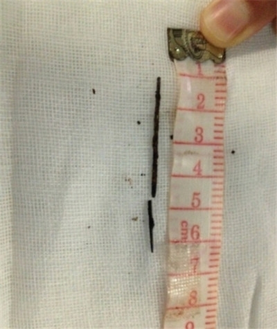 女子<em>胸腔取出钢针</em> 进入肺部多年已段成两截 揭