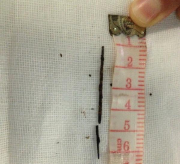 <em>女孩胸腔取出</em>5厘米长<em>钢针</em> 距锁骨下动脉仅1厘