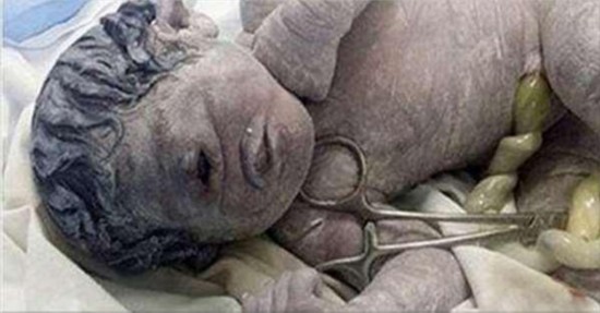 慎入! 埃及婴儿 只有 一只眼睛  如神话中独眼巨人