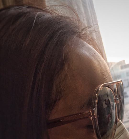  杨幂 撞到玻璃 额头撞出大包  网友:怎么这么不小