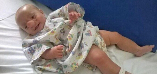 英国婴儿天生缺陷神似匹诺曹 其母曾被严厉批