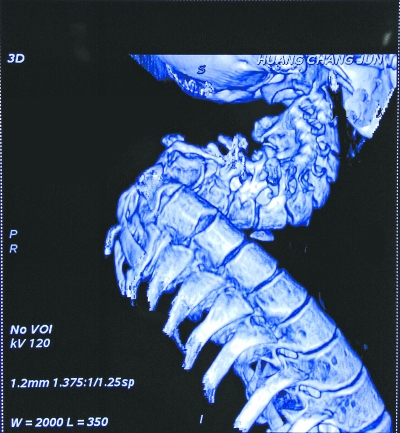 脊柱弯曲像麻花 找份工作讨个媳妇都很难(组图