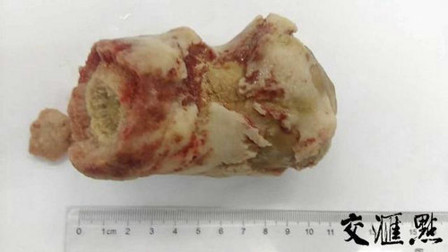 连云港一男子 膀胱 内 取出 一整块 2斤 重 结石  惊呆